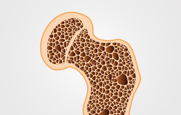 骨粗鬆症